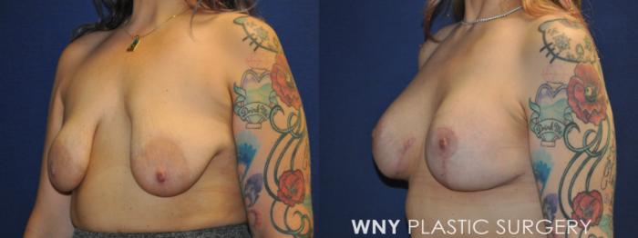 Before & After Breast Augmentation Case 235 Left Oblique View in Buffalo, NY