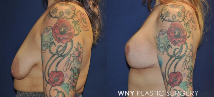 Before & After Breast Lift Case 235 Left Side View in Buffalo, NY