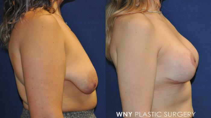 Before & After Breast Lift Case 235 Right Side View in Buffalo, NY