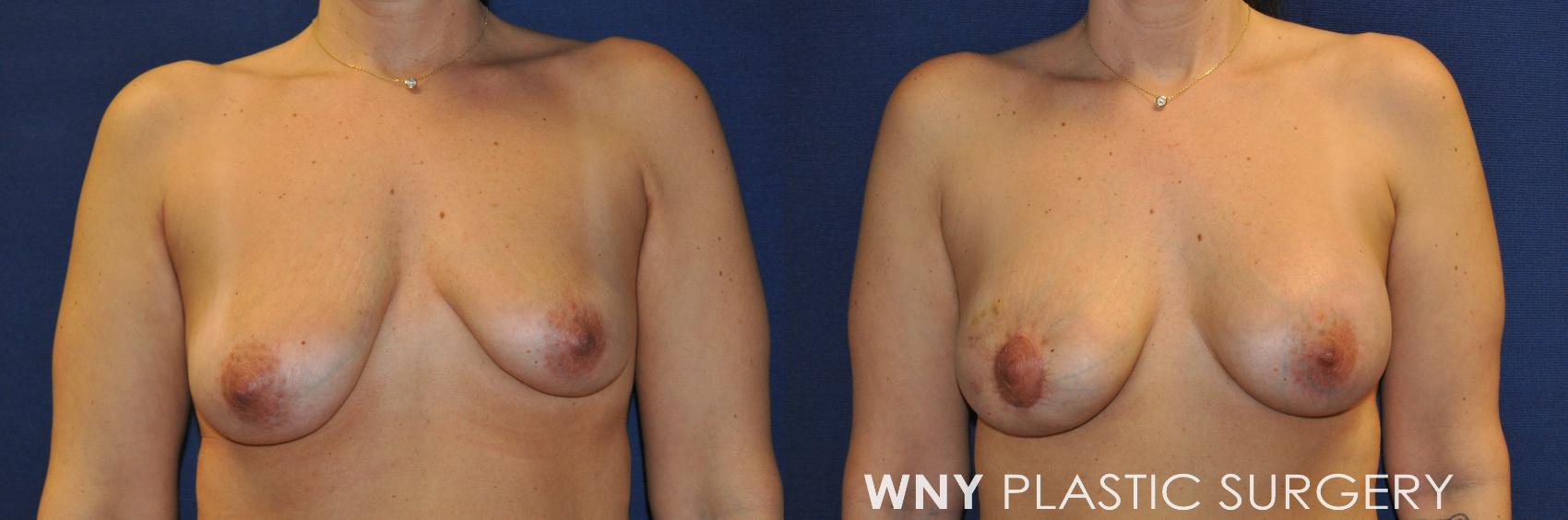 Before & After Breast Augmentation Case 239 Front View in Buffalo, NY