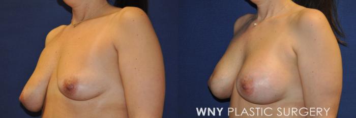 Before & After Breast Augmentation Case 239 Left Oblique View in Buffalo, NY
