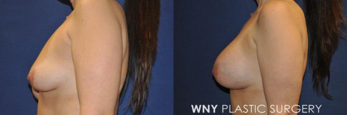 Before & After Breast Augmentation Case 239 Left Side View in Buffalo, NY