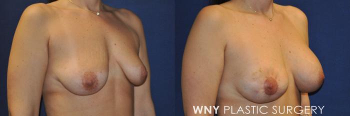 Before & After Breast Augmentation Case 239 Right Oblique View in Buffalo, NY