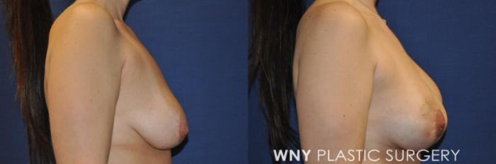 Before & After Breast Augmentation Case 239 Right Side View in Buffalo, NY