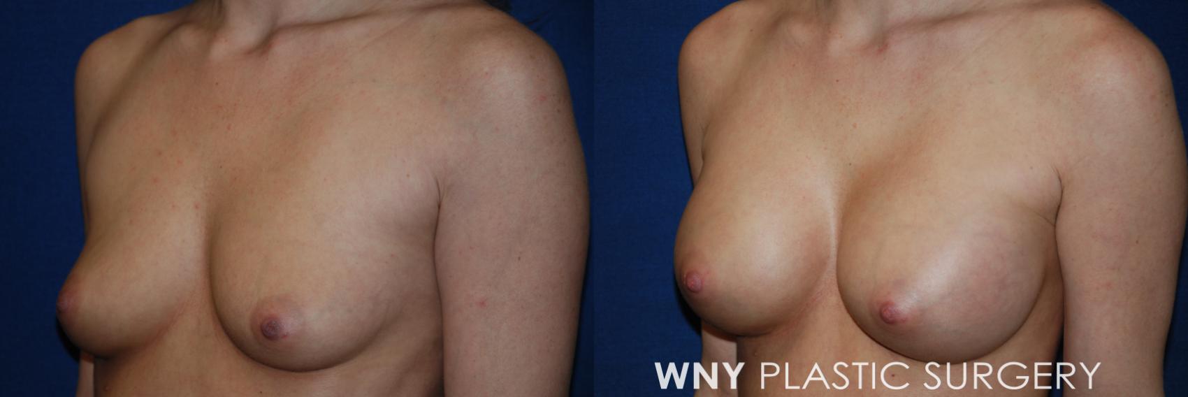 Before & After Breast Augmentation Case 47 Left Side View in Williamsville, NY
