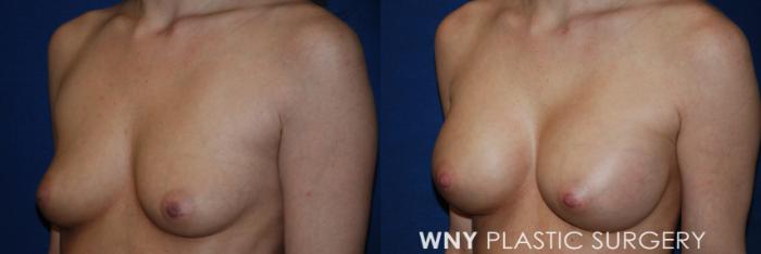 Before & After Breast Augmentation Case 47 Left Side View in Williamsville, NY