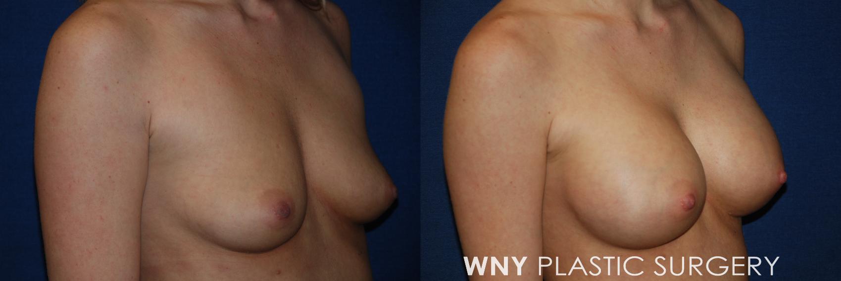 Before & After Breast Augmentation Case 47 Right Side View in Williamsville, NY