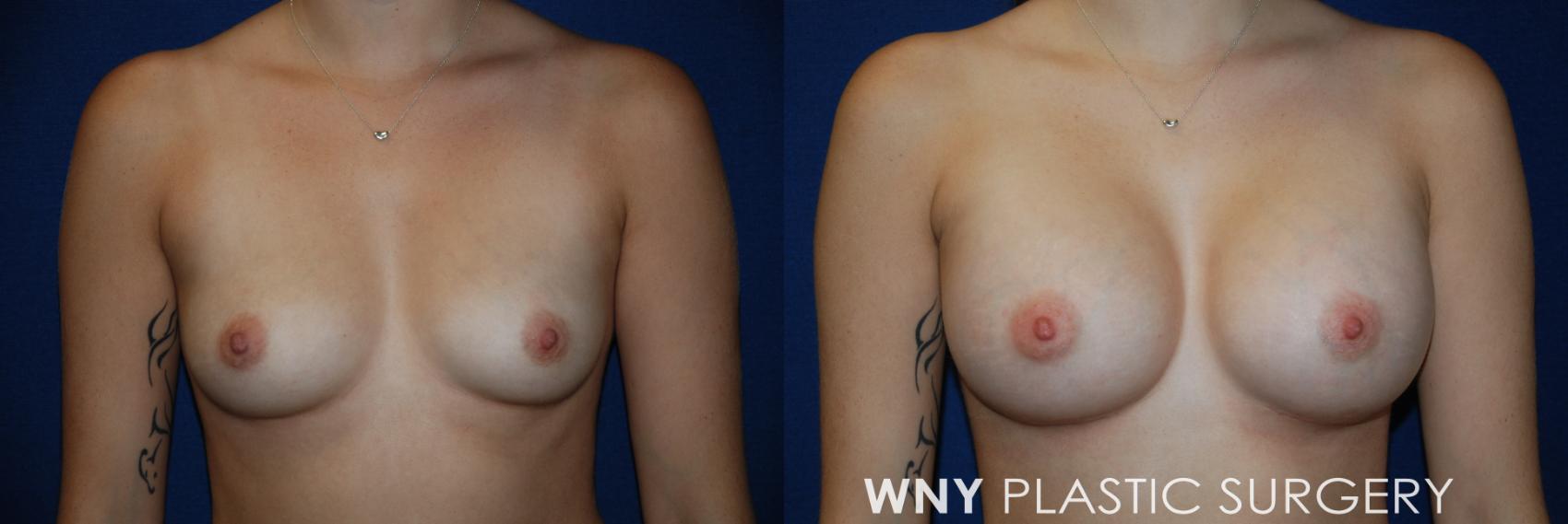 Before & After Breast Augmentation Case 48 View #1 View in Buffalo, NY
