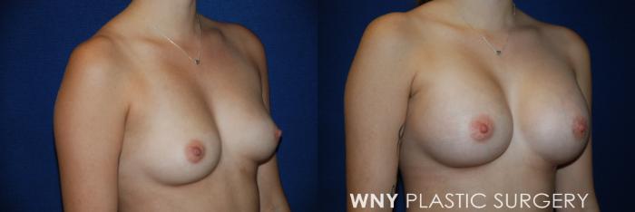 Before & After Breast Augmentation Case 48 View #2 View in Buffalo, NY