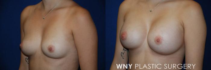Before & After Breast Augmentation Case 48 View #3 View in Buffalo, NY