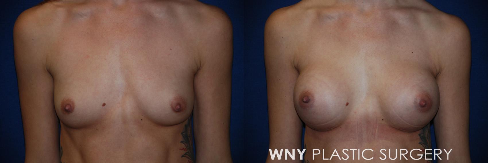 Before & After Breast Augmentation Case 49 View #1 View in Williamsville, NY