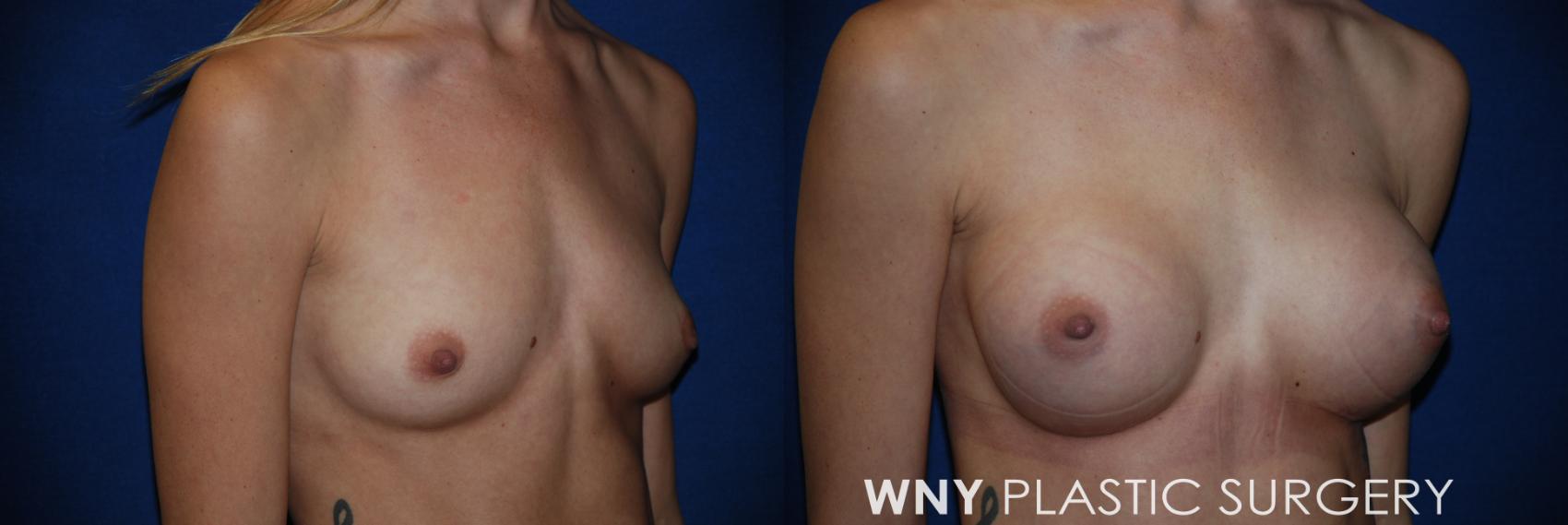 Before & After Breast Augmentation Case 49 View #2 View in Williamsville, NY