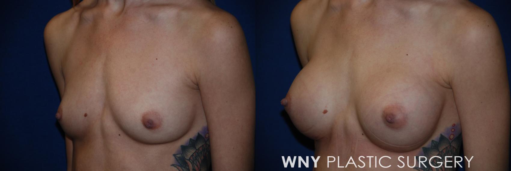Before & After Breast Augmentation Case 49 View #3 View in Williamsville, NY