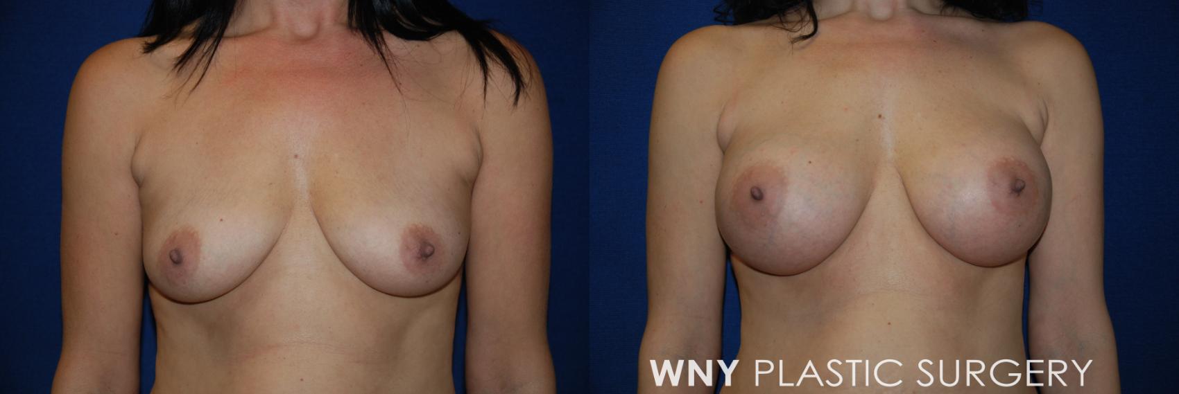 Before & After Breast Augmentation Case 50 View #1 View in Williamsville, NY