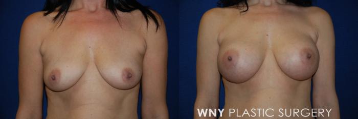 Before & After Breast Augmentation Case 50 View #1 View in Buffalo, NY