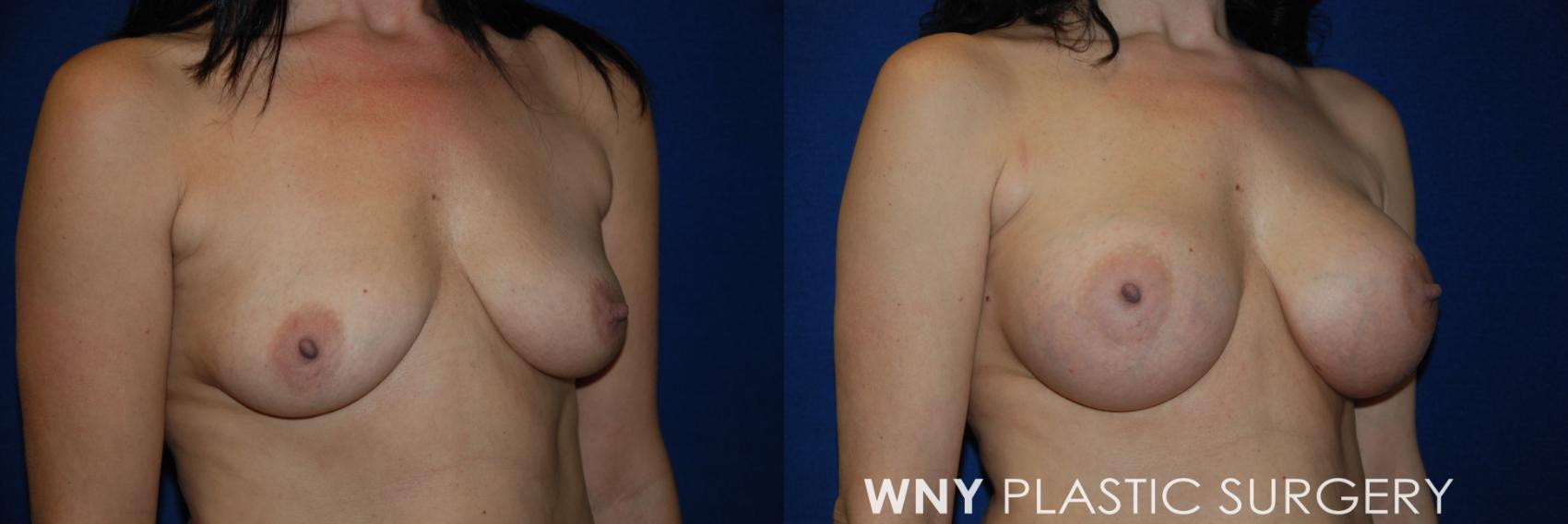 Before & After Breast Augmentation Case 50 View #2 View in Williamsville, NY