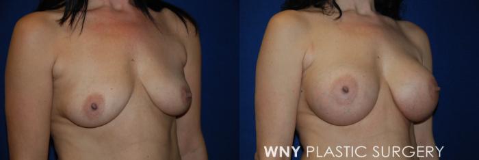 Before & After Breast Augmentation Case 50 View #2 View in Buffalo, NY