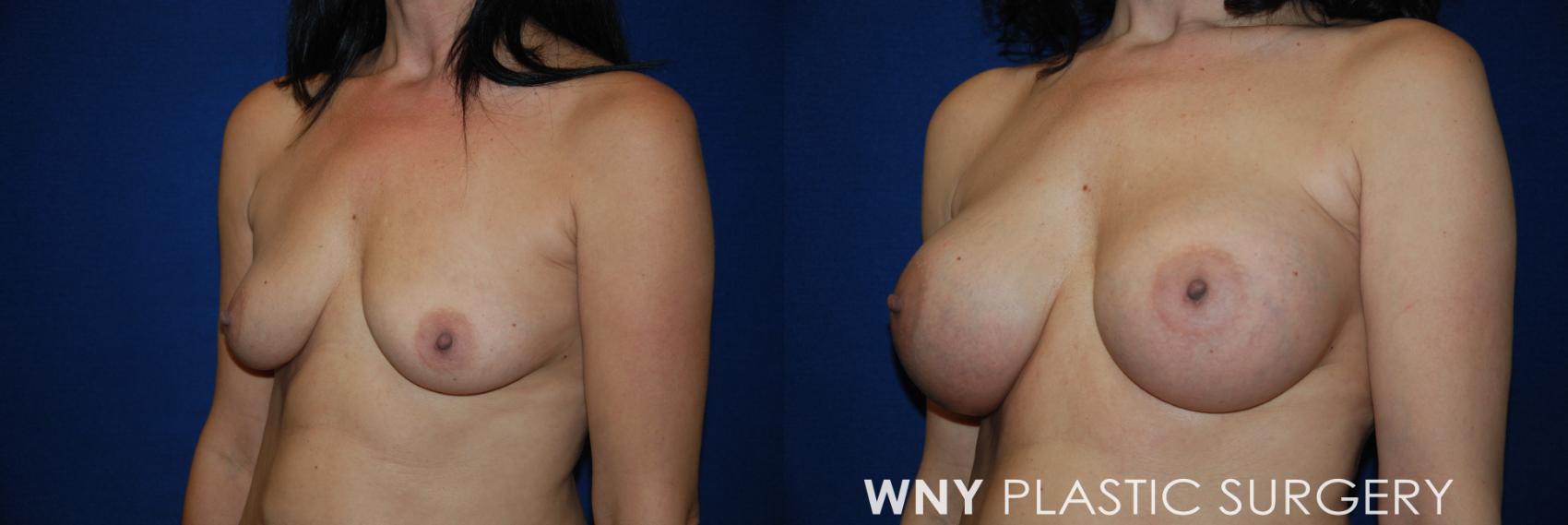 Before & After Breast Augmentation Case 50 View #3 View in Williamsville, NY
