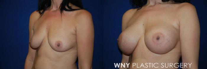 Before & After Breast Augmentation Case 50 View #3 View in Buffalo, NY