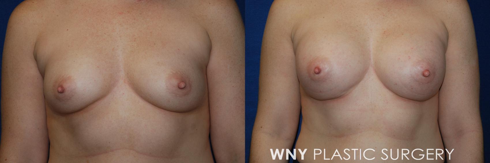 Before & After Breast Augmentation Case 54 View #1 View in Buffalo, NY