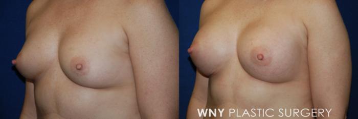Before & After Breast Augmentation Case 54 View #2 View in Buffalo, NY