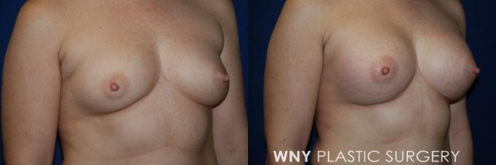 Before & After Breast Augmentation Case 54 View #3 View in Buffalo, NY