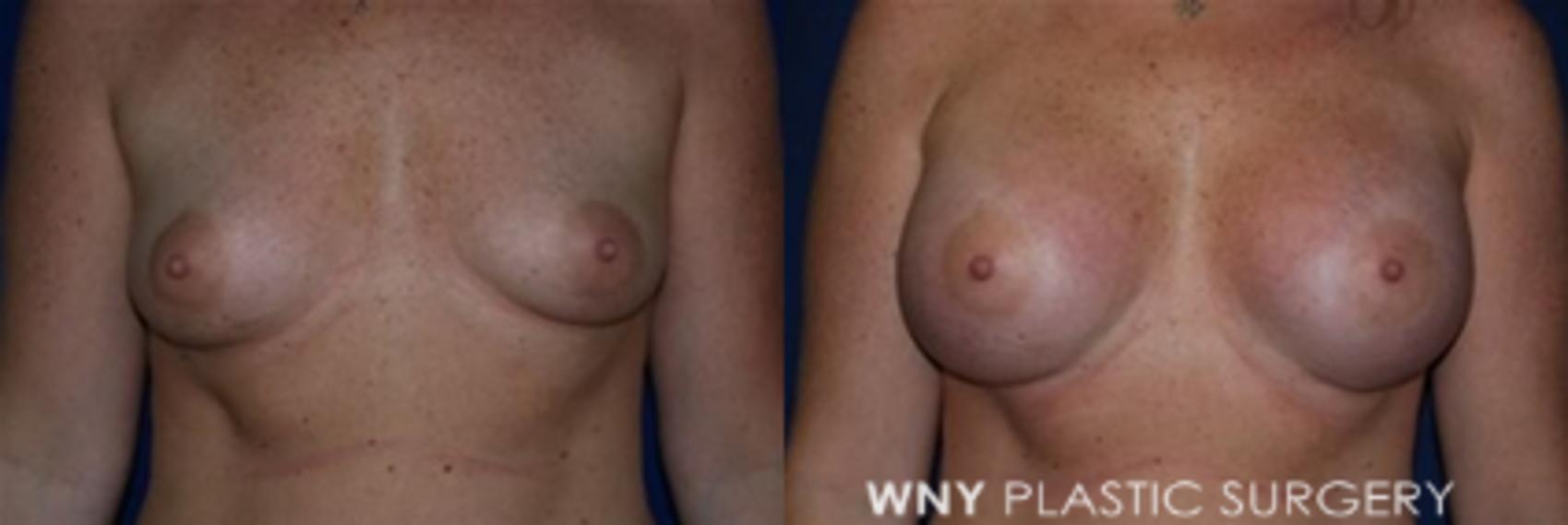 Before & After Breast Augmentation Case 6 View #1 View in Buffalo, NY