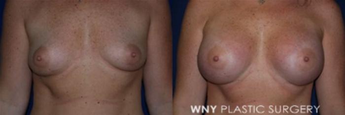 Before & After Breast Augmentation Case 6 View #1 View in Williamsville, NY