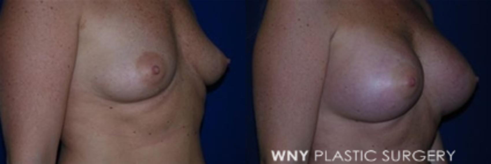 Before & After Breast Augmentation Case 6 View #2 View in Williamsville, NY