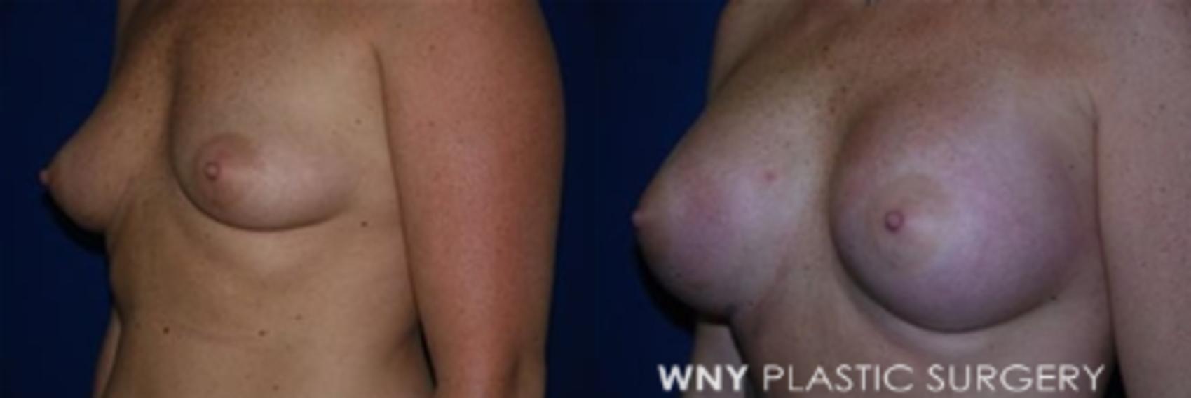 Before & After Breast Augmentation Case 6 View #3 View in Williamsville, NY