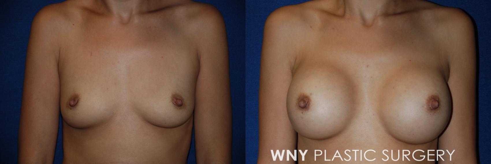 Before & After Breast Augmentation Case 61 View #1 View in Buffalo, NY