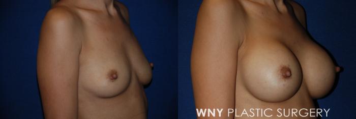 Before & After Breast Augmentation Case 61 View #2 View in Buffalo, NY