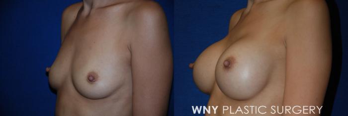 Before & After Breast Augmentation Case 61 View #3 View in Buffalo, NY