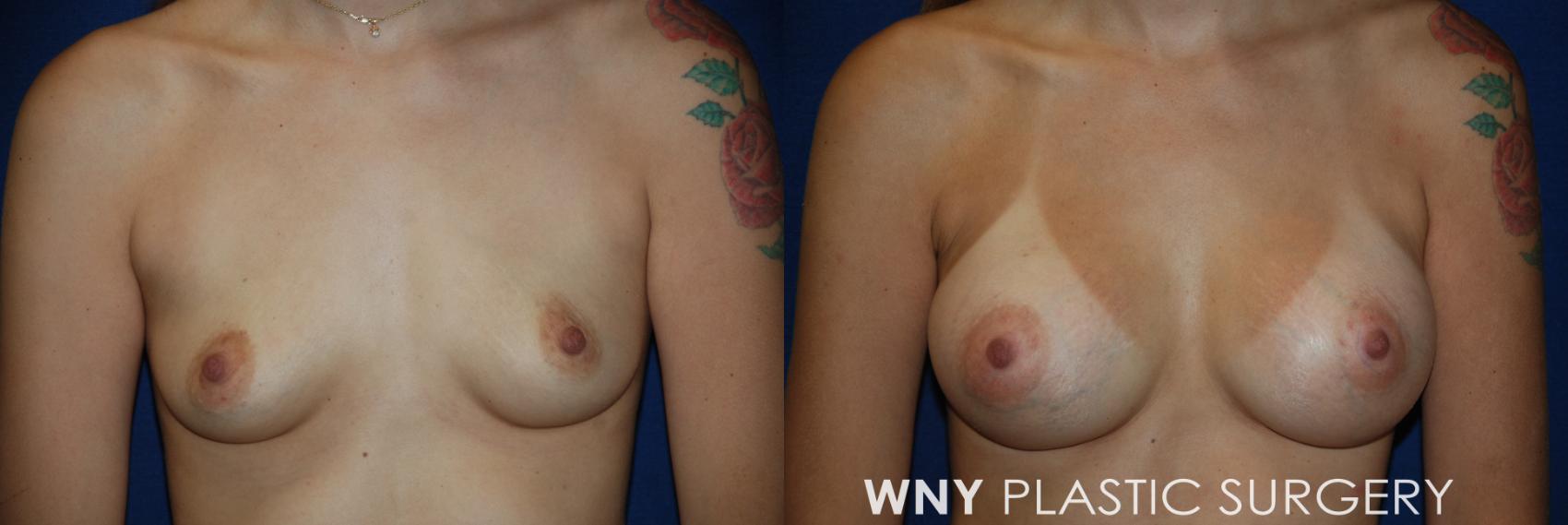 Before & After Breast Augmentation Case 63 View #1 View in Williamsville, NY