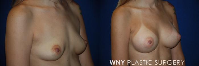 Before & After Breast Augmentation Case 63 View #2 View in Williamsville, NY