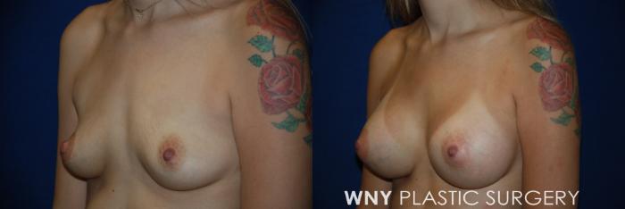 Before & After Breast Augmentation Case 63 View #3 View in Williamsville, NY