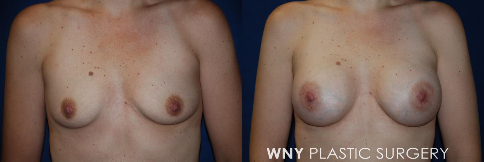 Before & After Breast Augmentation Case 64 View #1 View in Buffalo, NY