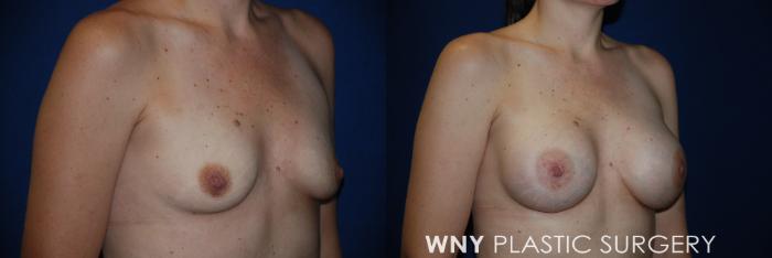 Before & After Breast Augmentation Case 64 View #2 View in Buffalo, NY