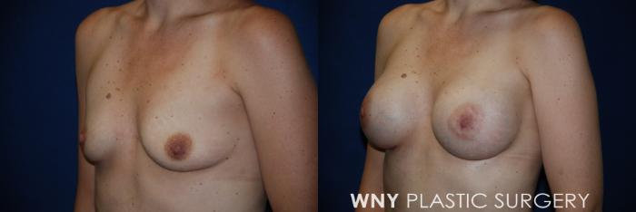 Before & After Breast Augmentation Case 64 View #3 View in Buffalo, NY