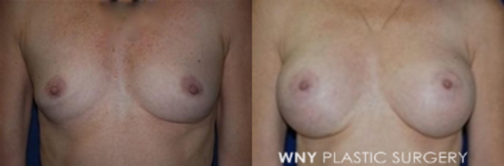 Before & After Breast Augmentation Case 7 Front View in Buffalo, NY