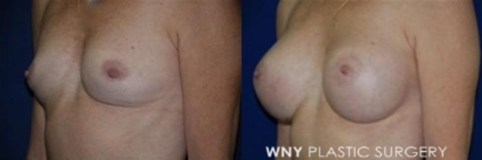 Before & After Breast Augmentation Case 7 Left Oblique View in Buffalo, NY