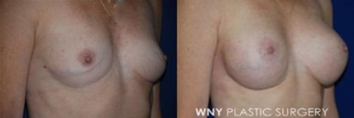 Before & After Breast Augmentation Case 7 Right Oblique View in Buffalo, NY