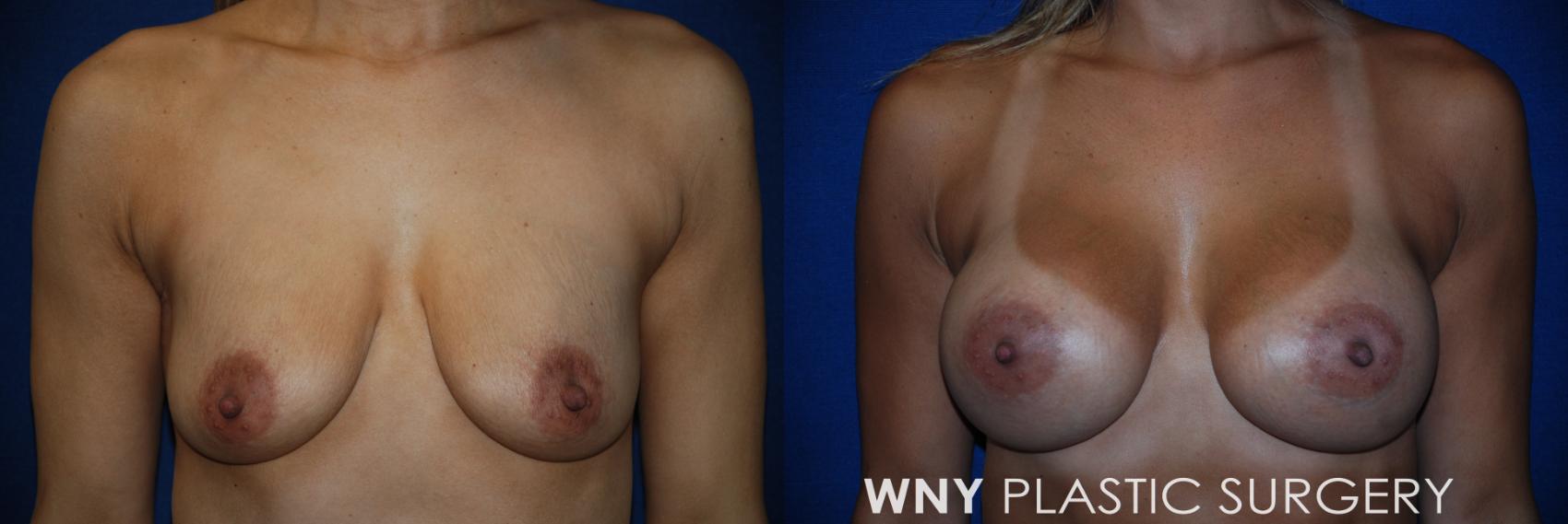 Before & After Breast Augmentation Case 74 View #1 View in Williamsville, NY