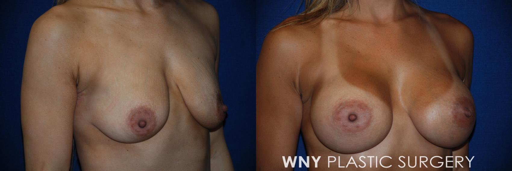 Before & After Breast Augmentation Case 74 View #2 View in Williamsville, NY