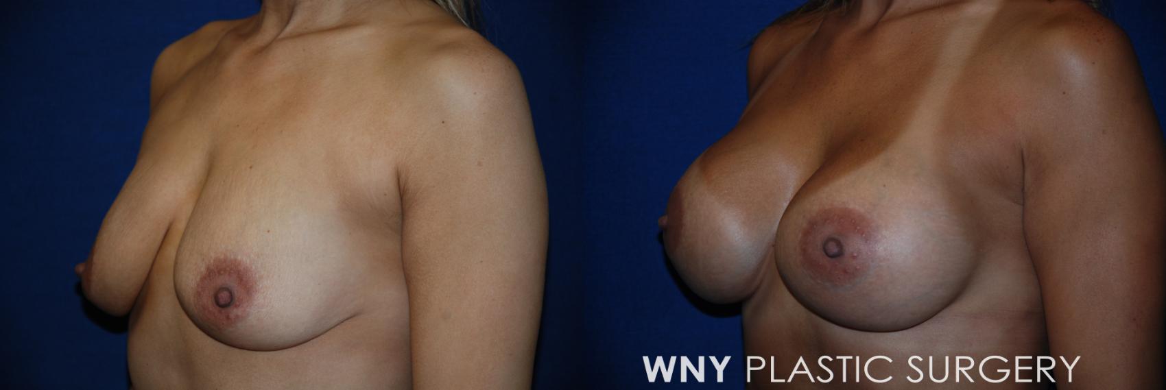 Before & After Breast Augmentation Case 74 View #3 View in Williamsville, NY