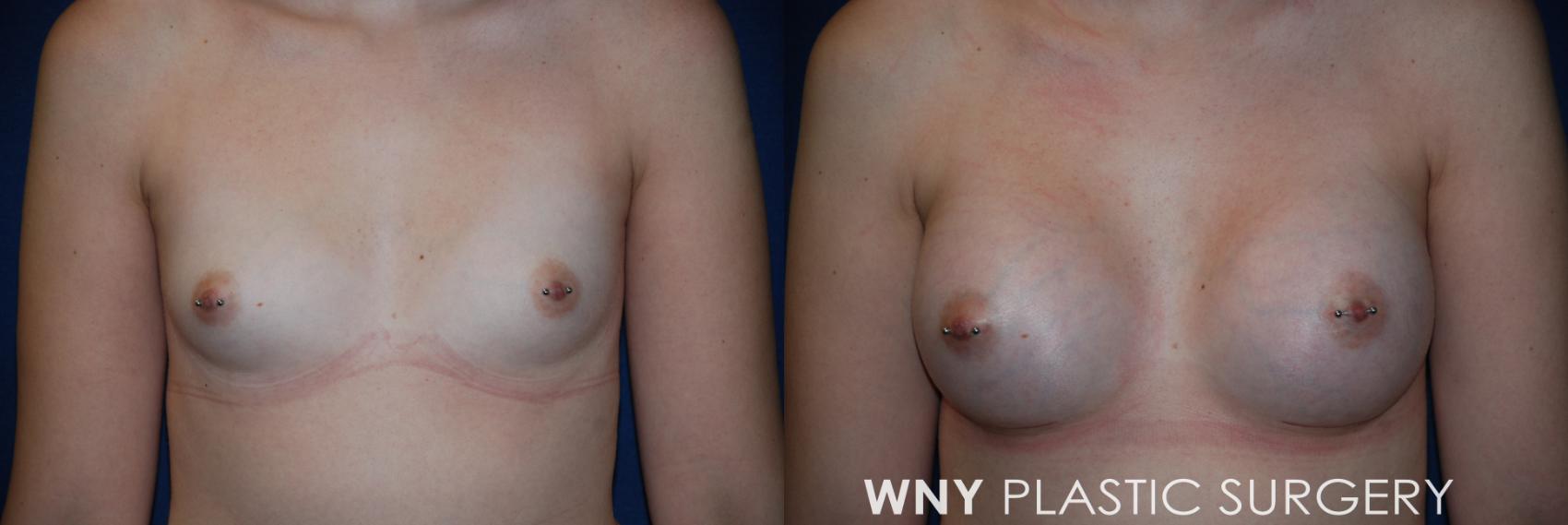 Before & After Breast Augmentation Case 75 View #1 View in Williamsville, NY