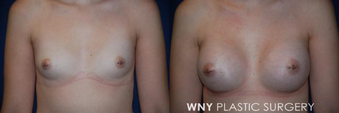 Before & After Breast Augmentation Case 75 View #1 View in Buffalo, NY