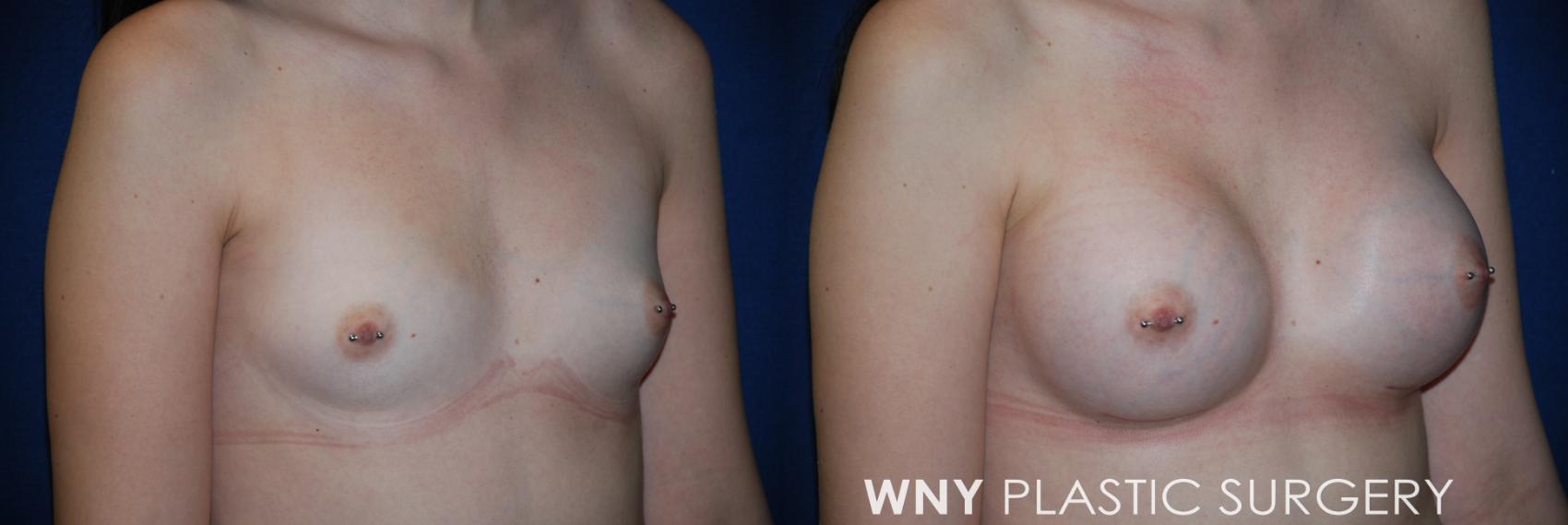 Before & After Breast Augmentation Case 75 View #2 View in Williamsville, NY