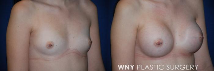 Before & After Breast Augmentation Case 75 View #2 View in Buffalo, NY