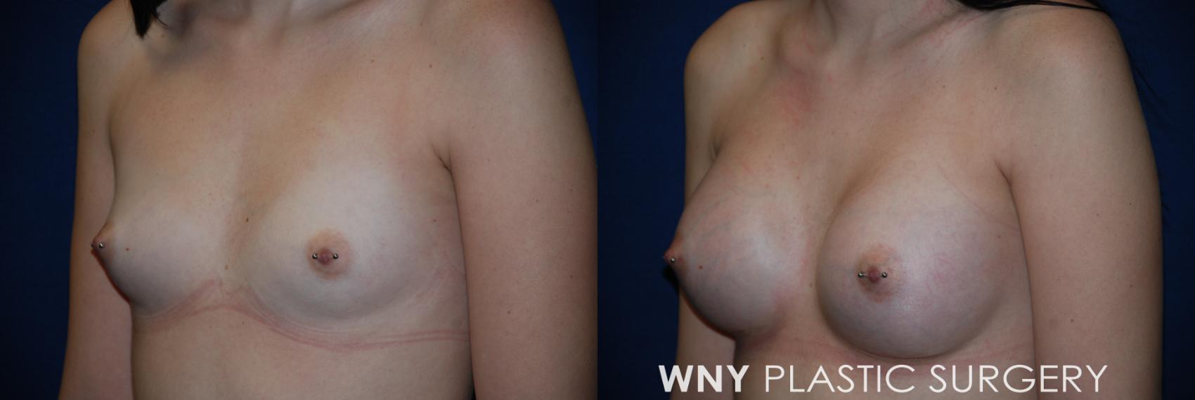 Before & After Breast Augmentation Case 75 View #3 View in Williamsville, NY